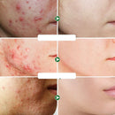 Creme Facial Antiacne - Tratamento para Espinhas